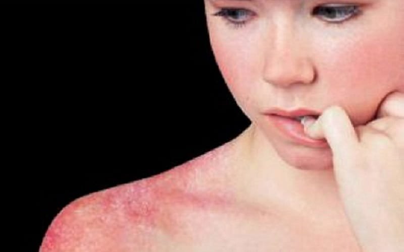 DF poderá ter um dia dedicado ao combate ao Lúpus