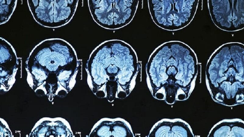 Nova droga promete retardar a evolução da Alzheimer