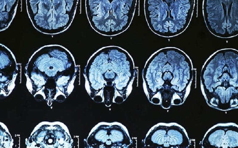 Alzheimer doença cura remédios Misto Brasil