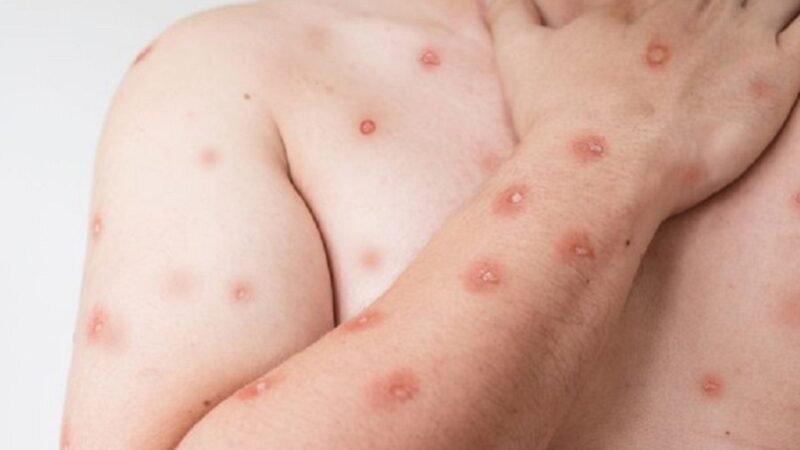 Primeiro caso de infecção pela cepa 1b da mpox no Brasil