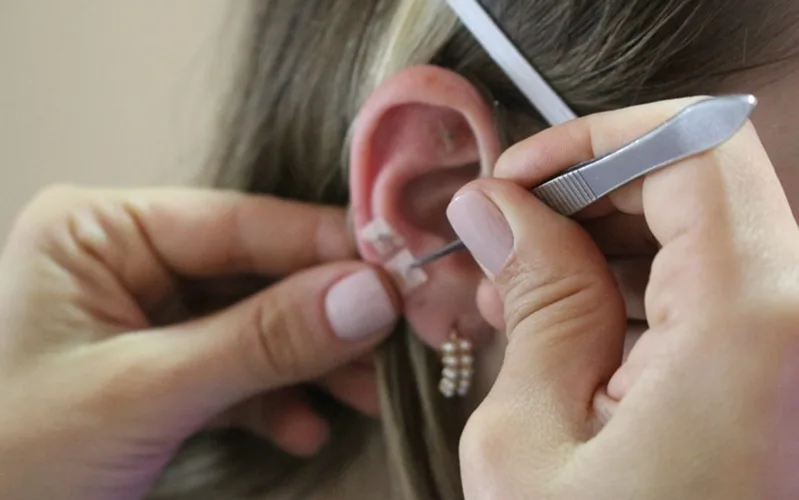 Acupuntura passa a ser profissão a partir de hoje