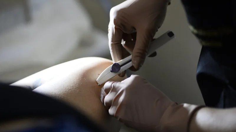 Rede pública recebeu o implante contraceptivo Implanon