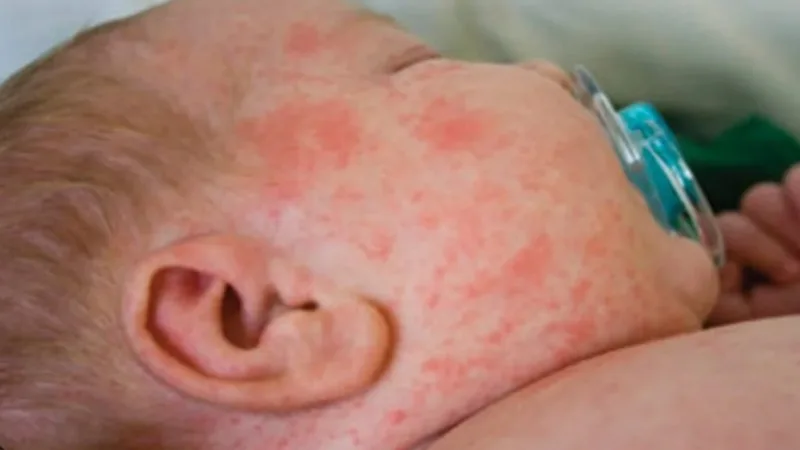 Casos de sarampo devem aumentar nas Américas