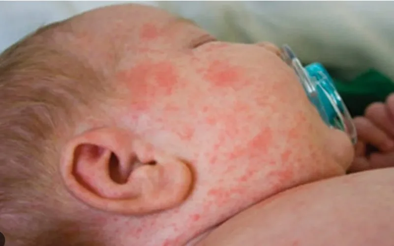 Casos de sarampo devem aumentar nas Américas